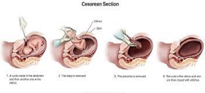 C-Section Part2